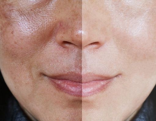 Vitamin Untuk Mengatasi Bercak Melasma