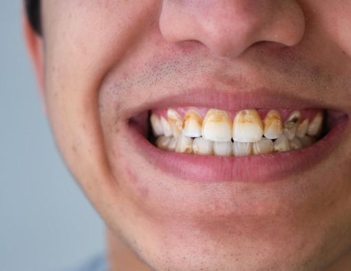 4 Faktor Penyebab Karang Gigi yang Harus Dihindari