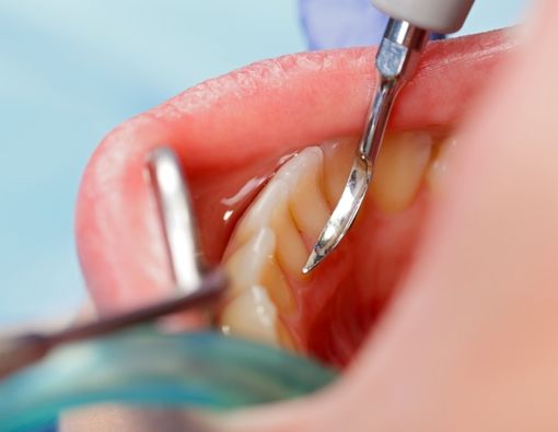 Berbagai Cara Mencegah Karang Gigi yang Mudah Dilakukan