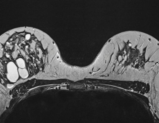 Fakta Seputar Mamografi Payudara yang Mesti Anda Ketahui