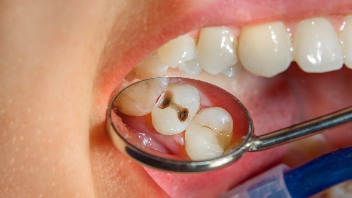 Adakah Pengaruh Gigi Berlubang Terhadap Tes Kesehatan? (Sergii-Kuchugurnyi/Shutterstock)