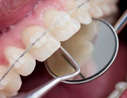 Pakai Behel Bisa Bikin Gigi Kuning, Ini Alasannya