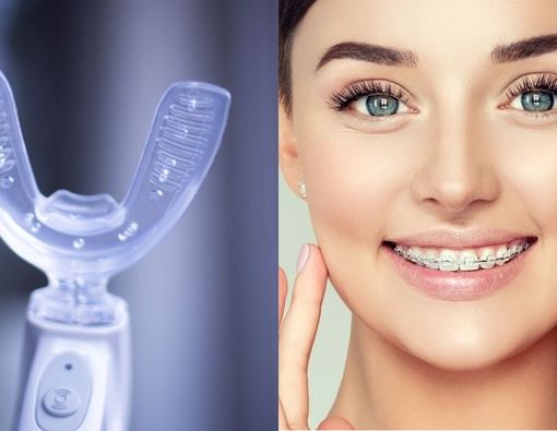 Kawat Gigi atau Aligners, Mana yang Lebih Higienis?