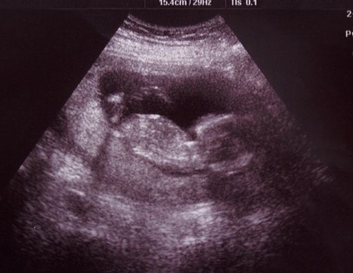 Janin Meninggal Tanpa Tanda Keguguran, Waspada Missed Abortion