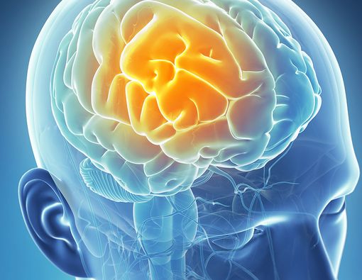 Ini Bedanya Strok Iskemik dan Hemoragik