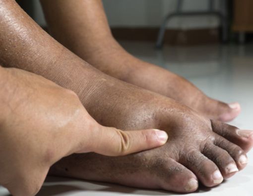 Pertolongan Pertama pada Kaki Bengkak Akibat Tertindih Perabotan