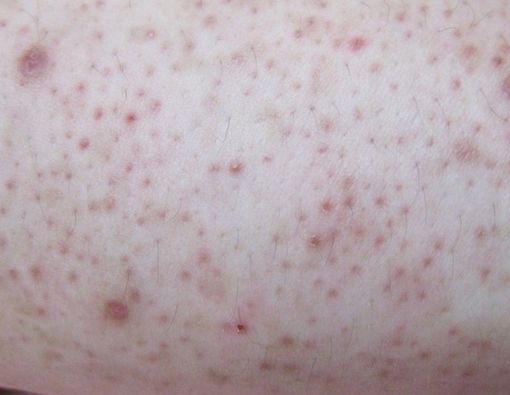 Cara Mengatasi dan Mencegah Penyakit Kulit Ayam