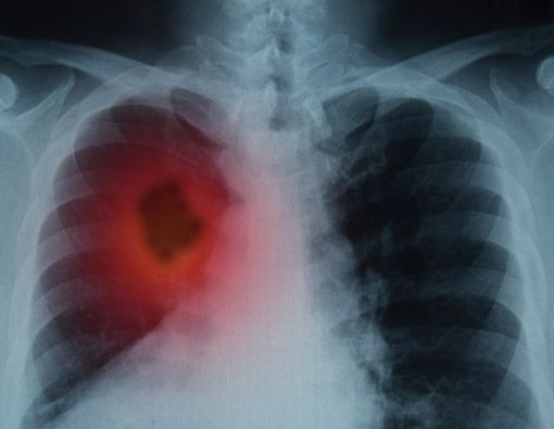 Tumor di Paru Pertanda Kanker Paru, Benarkah?