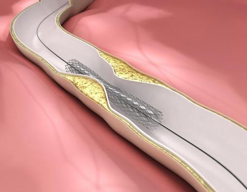 Kapan Ring Jantung Diperlukan?