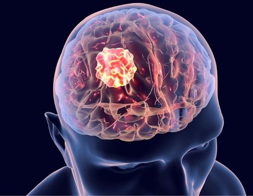 Bahan Alami yang Bantu Menghambat Pertumbuhan Sel Kanker Otak