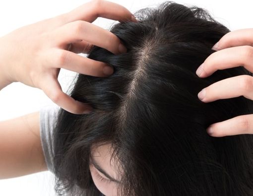 Penyebab Kulit Kepala Gatal Saat Hamil dan Cara Mengatasinya