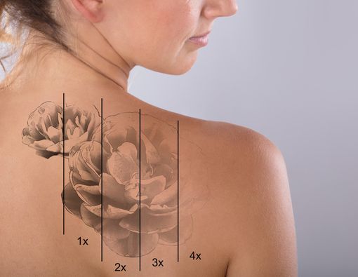 5 Pilihan Cara untuk Menghapus Tato Permanen