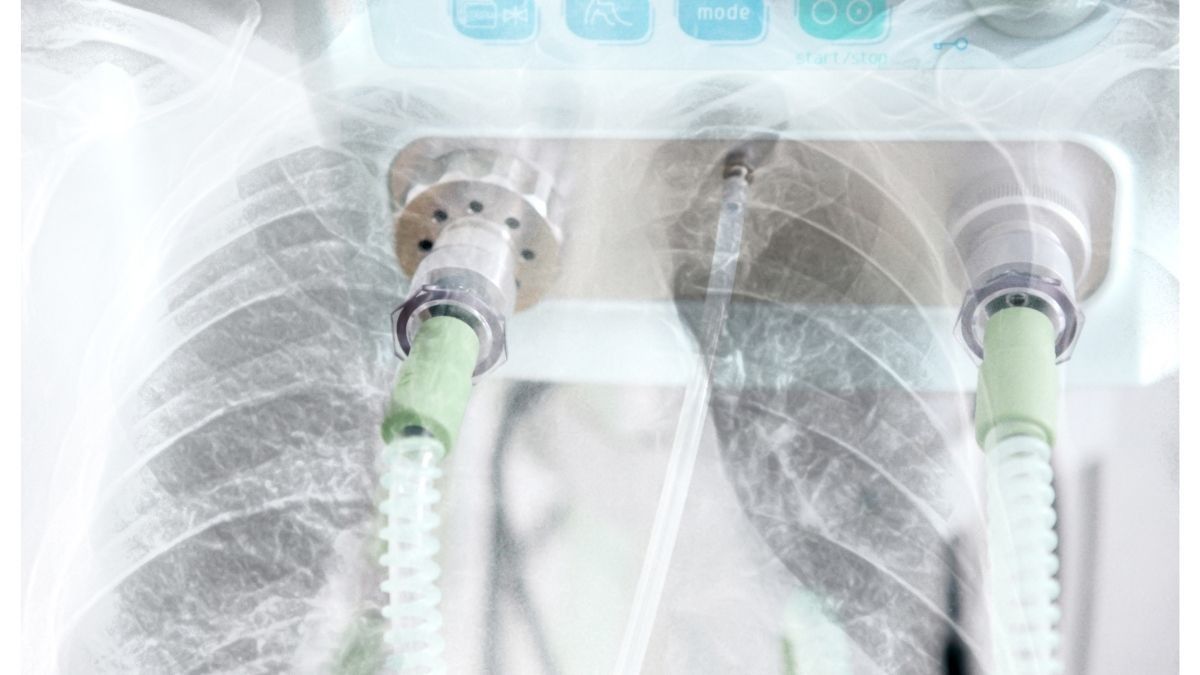 Terapi ECMO Kurangi Risiko Kematian Pasien COVID-19