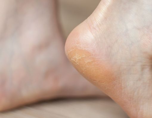 Tak Hanya Kulit Mengeras, Ini 4 Gejala Mata Ikan