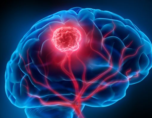 Waspada, Tumor Otak Tak Pandang Usia