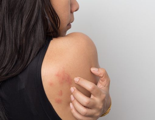 Mengapa Biduran Tak Boleh Digaruk?