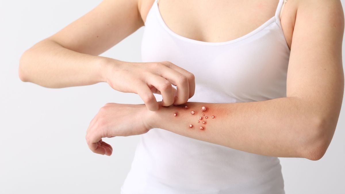 Cacar Monyet Bisa Menular Lewat Cara Ini