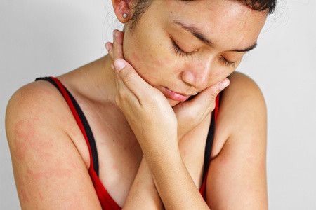 Tanda dan Gejala Alergi yang Sering Salah Dipersepsikan