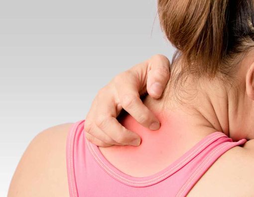 5 Ciri-Ciri Biang Keringat, Bukan Hanya Gatal Saja