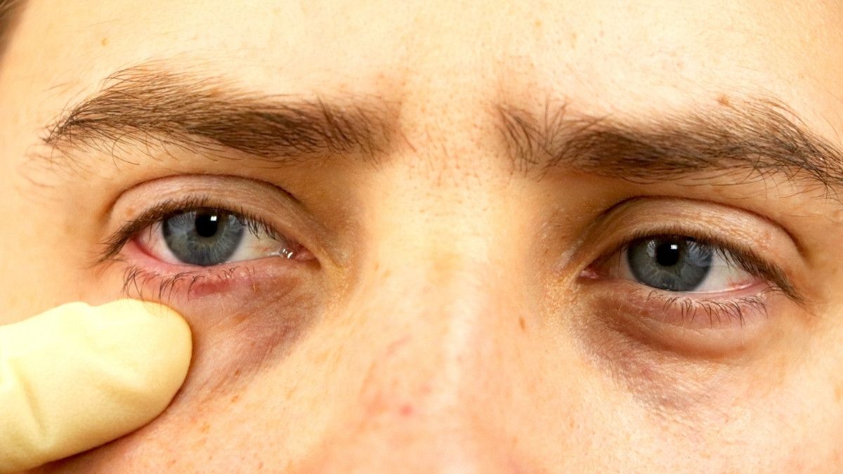 Waspada, Ini Efek Samping Steroid pada Penglihatan Anda