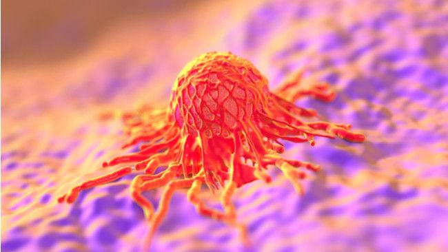 Keputihan Tak Kunjung Sembuh, Waspadai Gejala Kanker Serviks