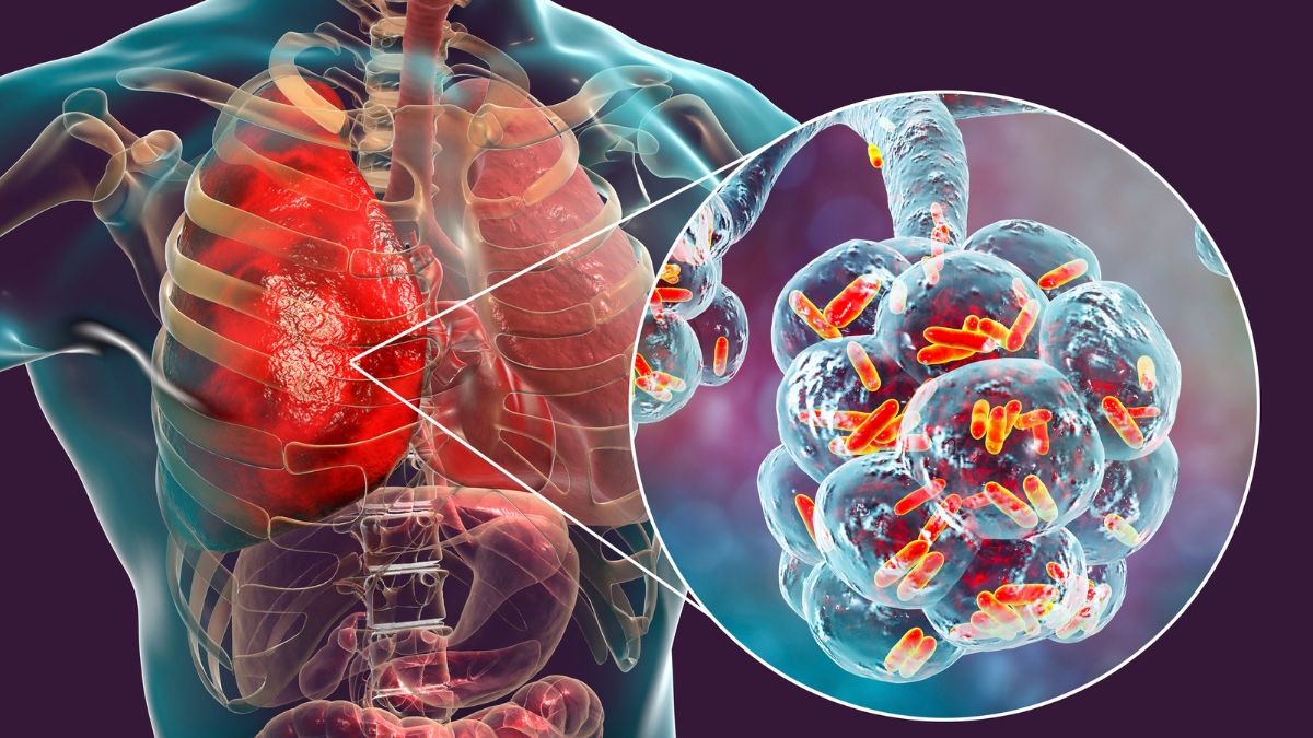 Pertolongan Pertama pada Penderita TBC