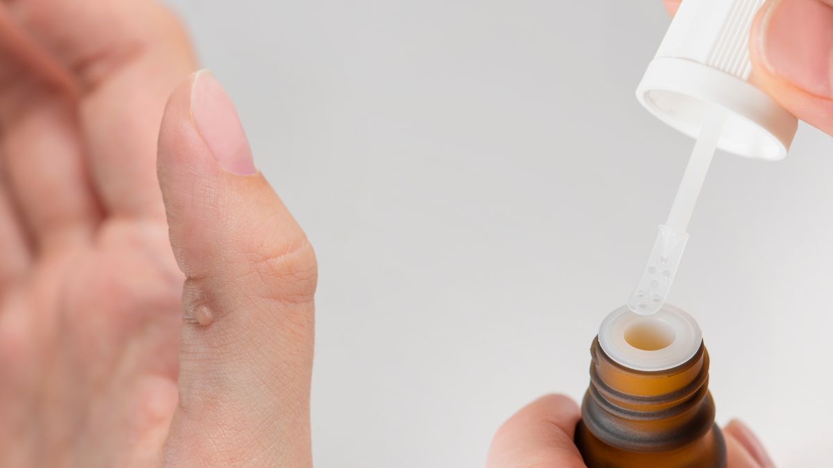 6 Jenis Obat Medis Penghilang Kutil