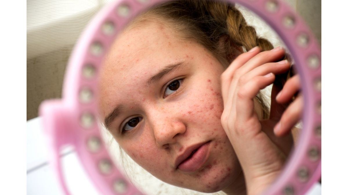 Acne Shaming dan Dampaknya pada Kesehatan Mental
