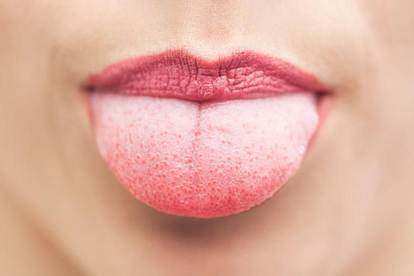 Benarkah Bercak Putih di Mulut Pertanda AIDS?