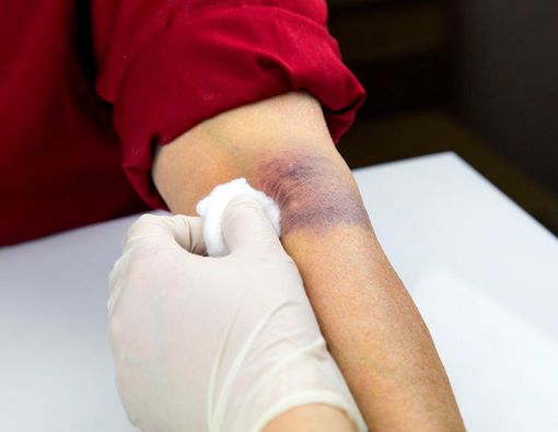 Cara Mudah untuk Hilangkan Memar