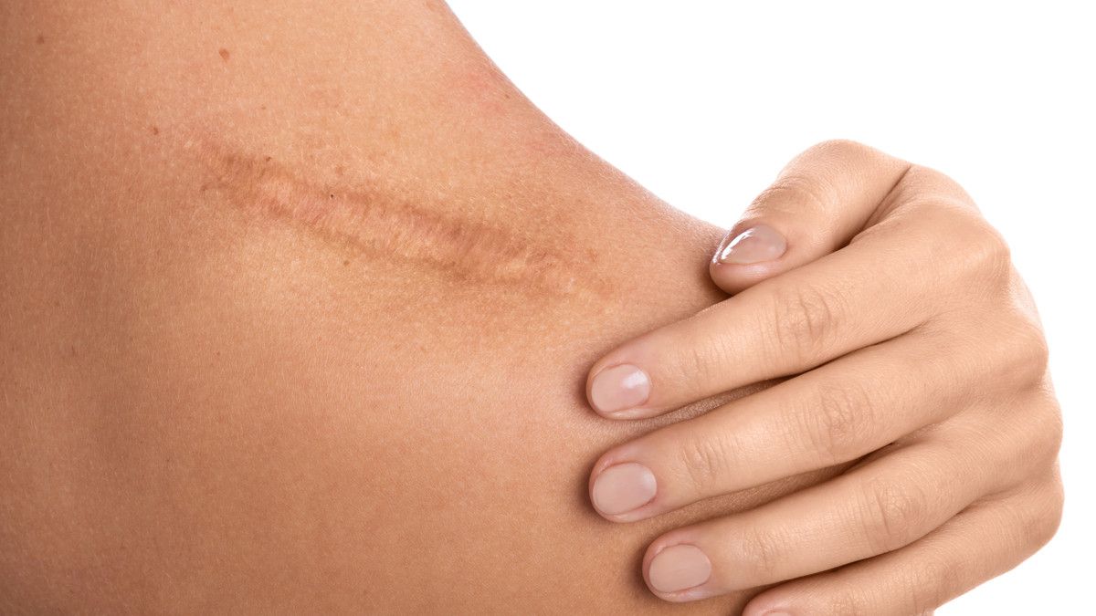 Punya Riwayat Keloid, Bolehkah Ditindik?