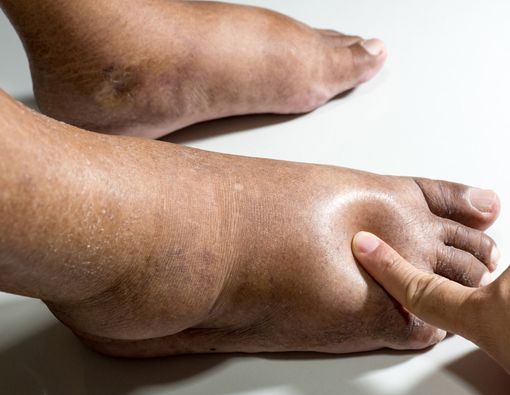 Hindari, Ini Berbagai Kebiasaan Buruk Pemicu Kaki Diabetes