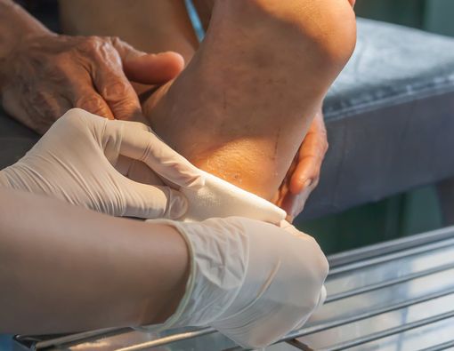 Dalam Kondisi Apa Luka (Kaki) Penderita Diabetes Harus Diamputasi?