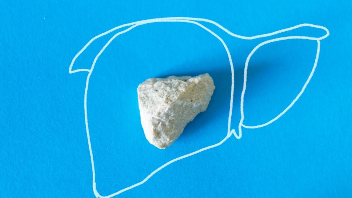 Mengenali Tanda-Tanda Batu Ginjal