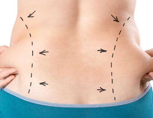 Fakta tentang Sedot Lemak, Cara Instan Hilangkan Lemak di Tubuh