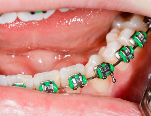 Berapa Kali Karet Behel Harus Diganti dalam Setahun?