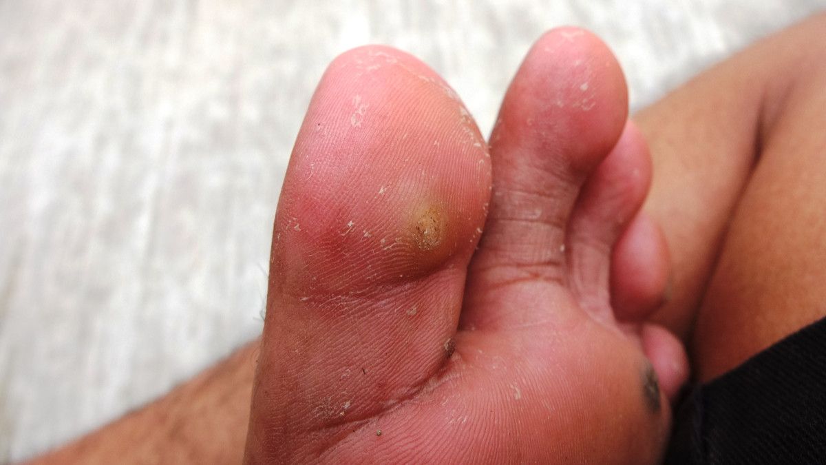 Kenali Penyebab Timbulnya Penyakit Kulit Mata Ikan