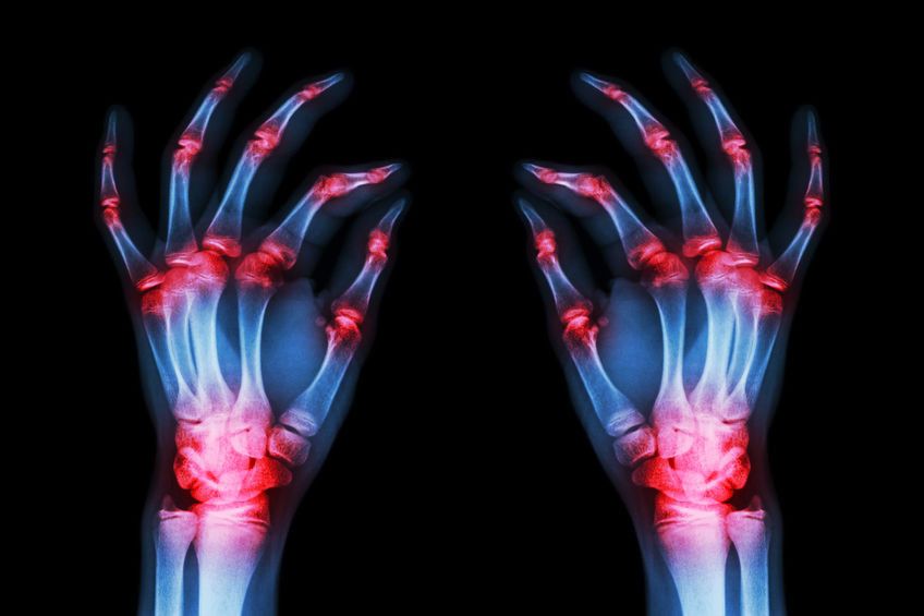 Inilah 5 Penyebab Utama Nyeri Sendi