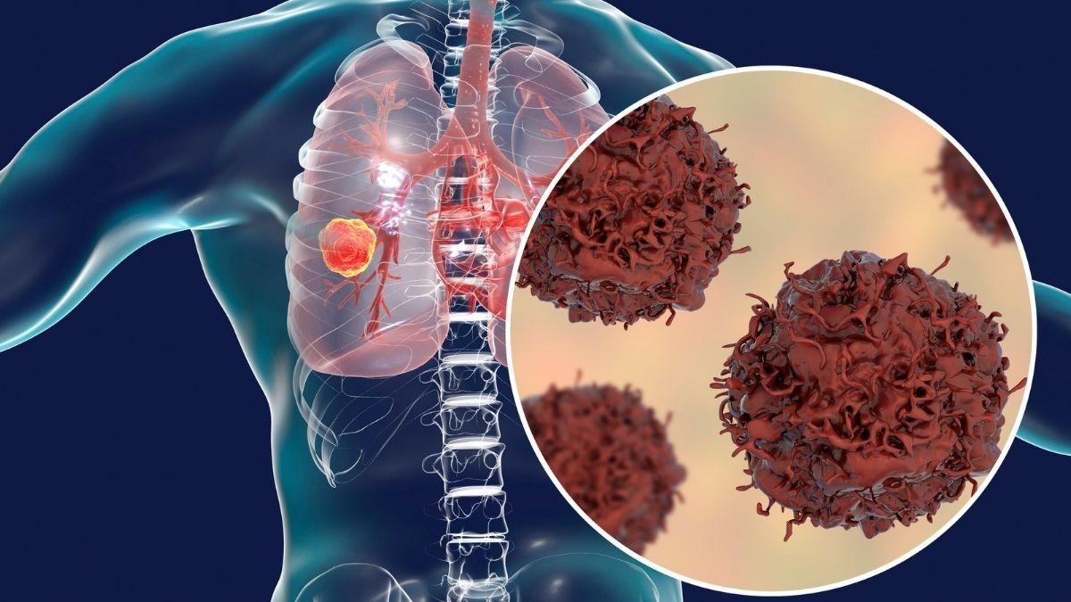 Kanker Paru Sel Kecil dan Gejalanya yang Mesti Diwaspadai