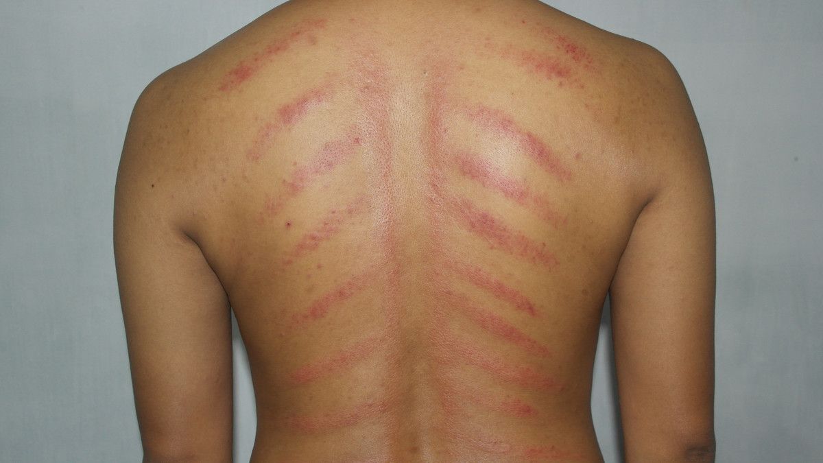 Kerokan Bawang Merah untuk Mengatasi Masuk Angin, Benarkah Ampuh?