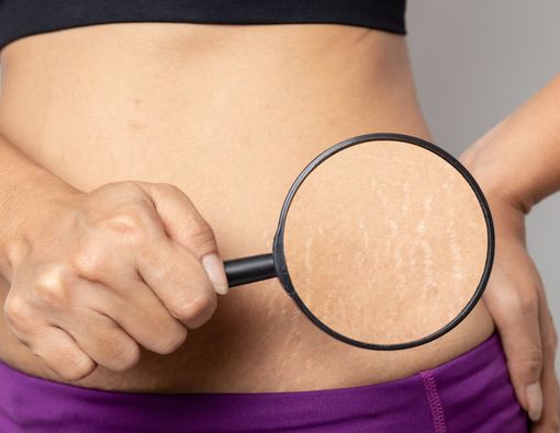Cara Menghilangkan Stretchmark Pasca Melahirkan