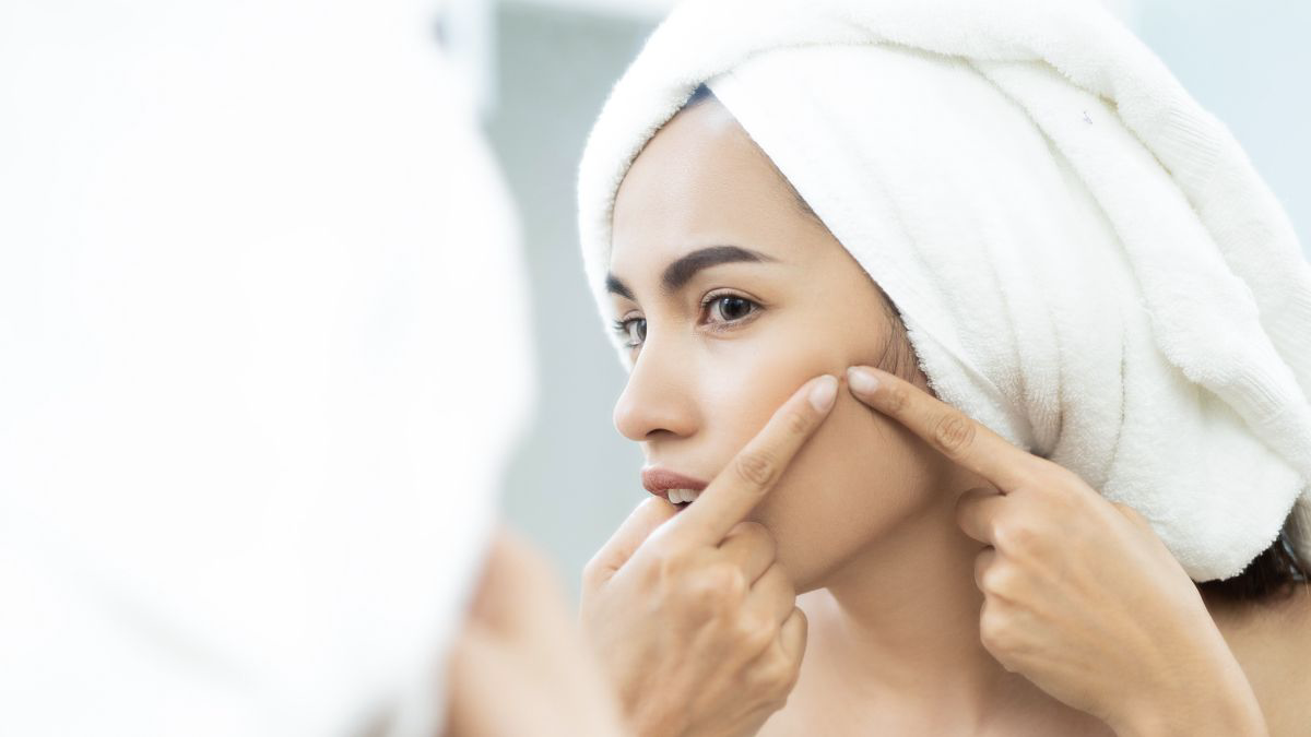 Serba-Serbi Acne Prone Skin, Kondisi Wajah Rentan Berjerawat