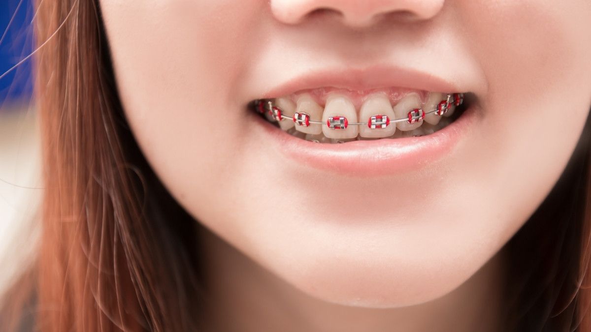 Tips Mengatasi Gusi Bengkak Akibat Kawat Gigi atau Behel