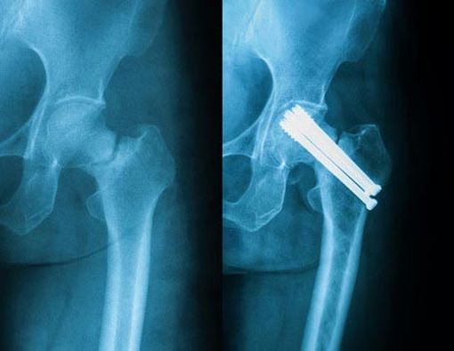 Penanganan untuk Patah Tulang Pinggul