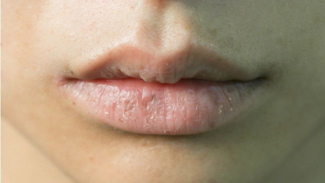 Atasi Bibir Kering dan Pecah-Pecah dengan Cara Alami Ini