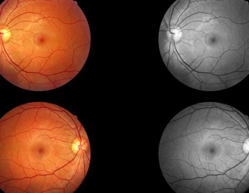 Faktor Genetik Penyebab Utama Retinoblastoma, Benarkah?