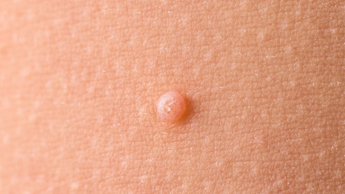 Mengenal Molluscum Contagiosum, Benjolan Mirip Jerawat pada Bayi