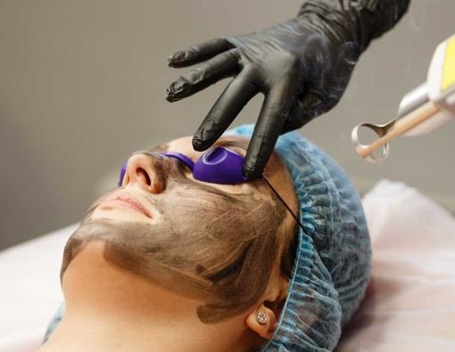 Mengenal Perawatan dan Manfaat Hollywood Laser Peel