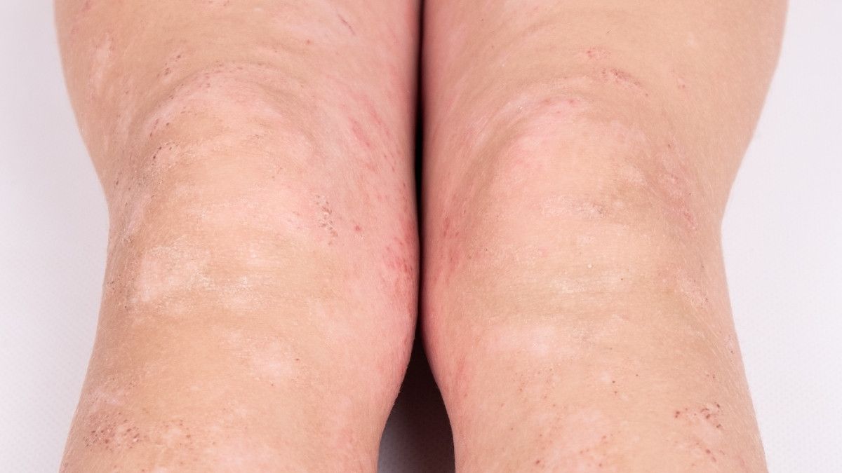 Cara Menangani Anafilaksis Pada Anak