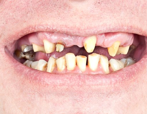 Masalah Kesehatan Gigi yang Sering Dialami Pengguna Narkoba